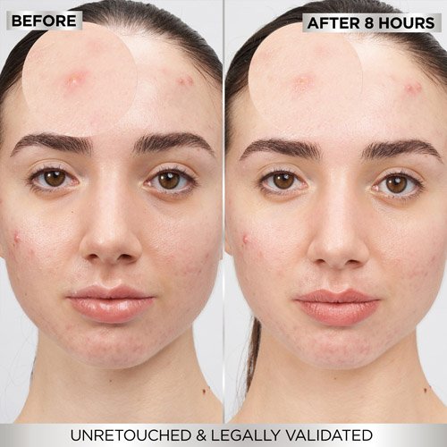 garnier ecom pimplepatch July2024 before after 3